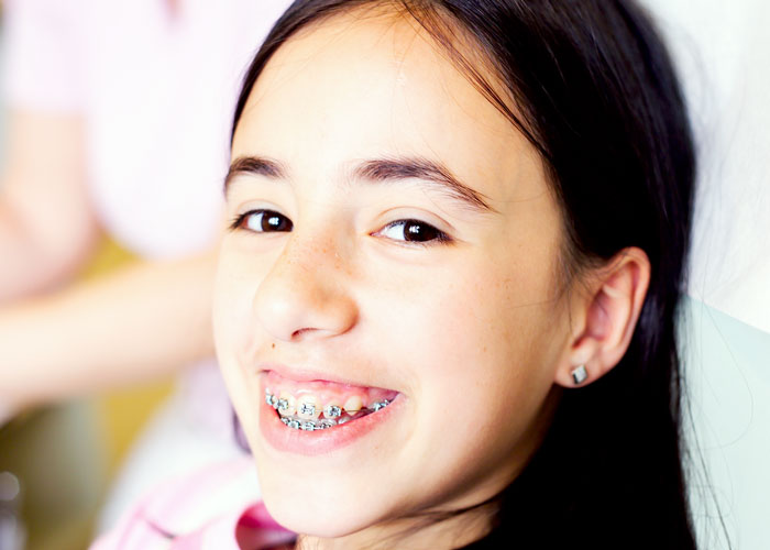 Kieferorthopädie: Mädchen mit Zahnspange